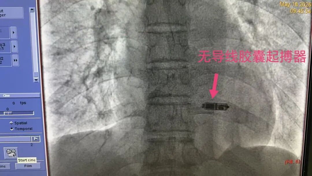 Leadless pacemaker case image from a partner hospital in Xi'an